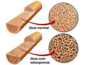 osteopenia e osteoporose